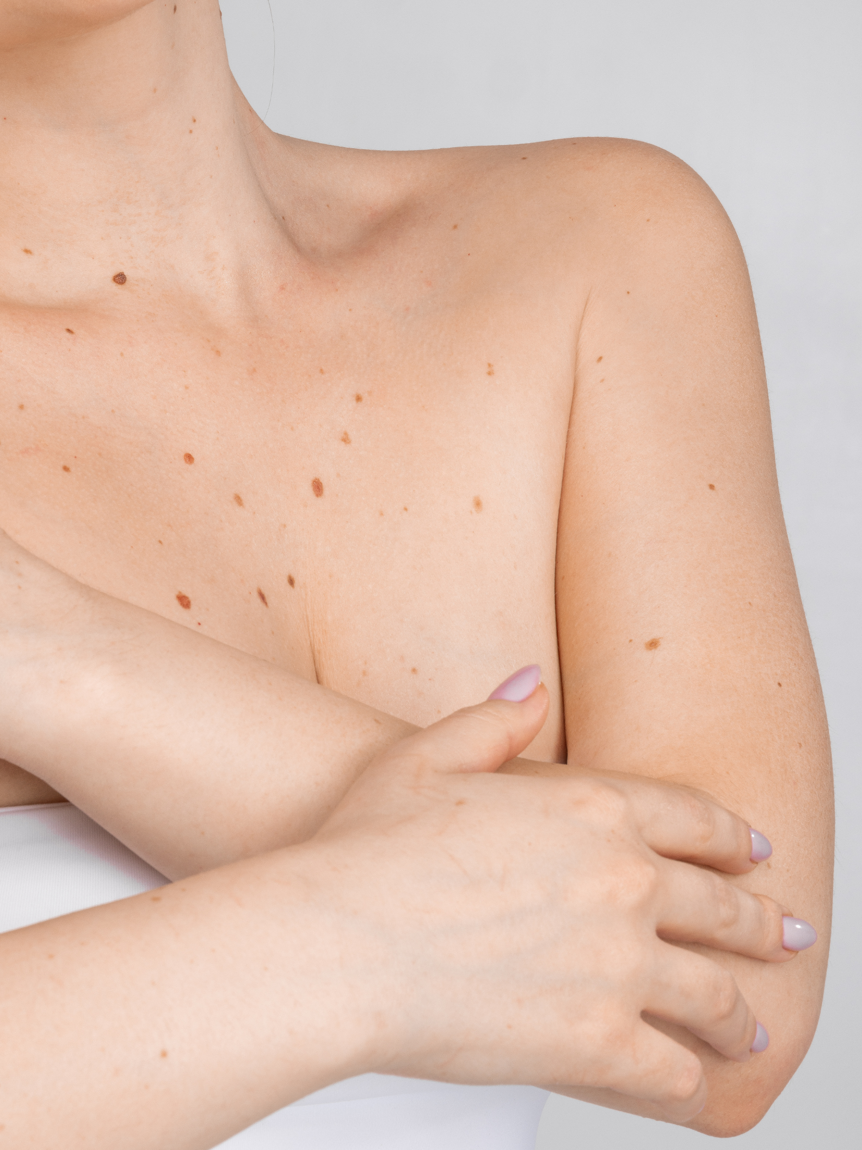Partial view of a person's torso with a focus on skin texture and mole details. 
